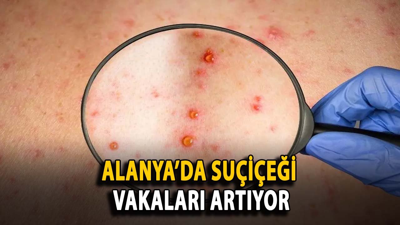 Alanya’da suçiçeği vakaları artıyor