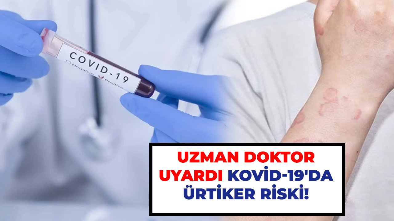 Uzman Doktor uyardı Kovid-19'da ürtiker riski!